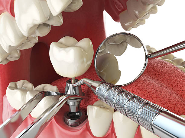 Best Emergency Root Canal Therapy in El Dorado, KS